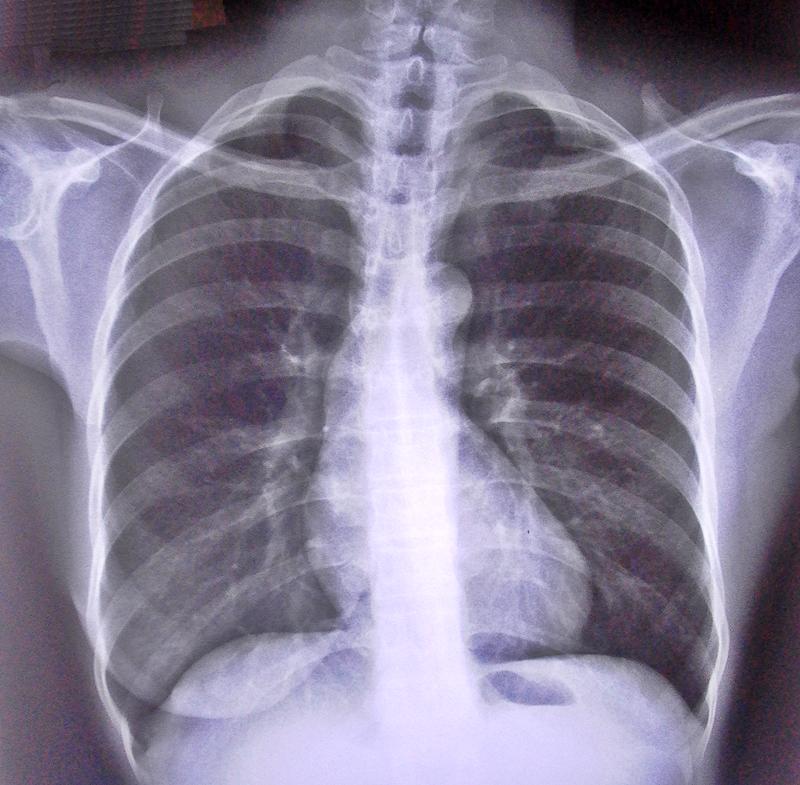 Zbadają płuca Brudzewianom - Źródło: sxc.hu / Adam Ciesielski