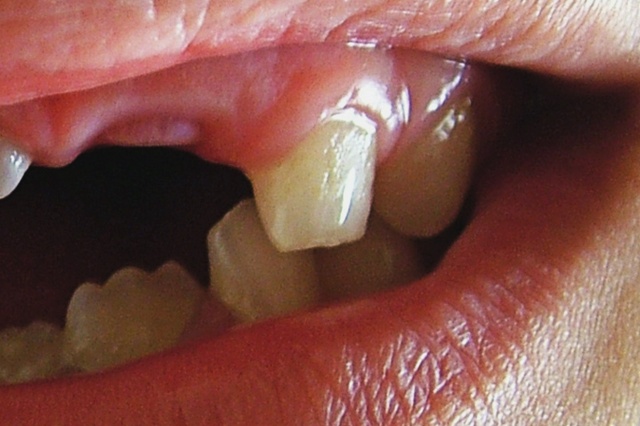 Chciał wykopać zęby z gęby - Źródło: sxc.hu / Megan Brock