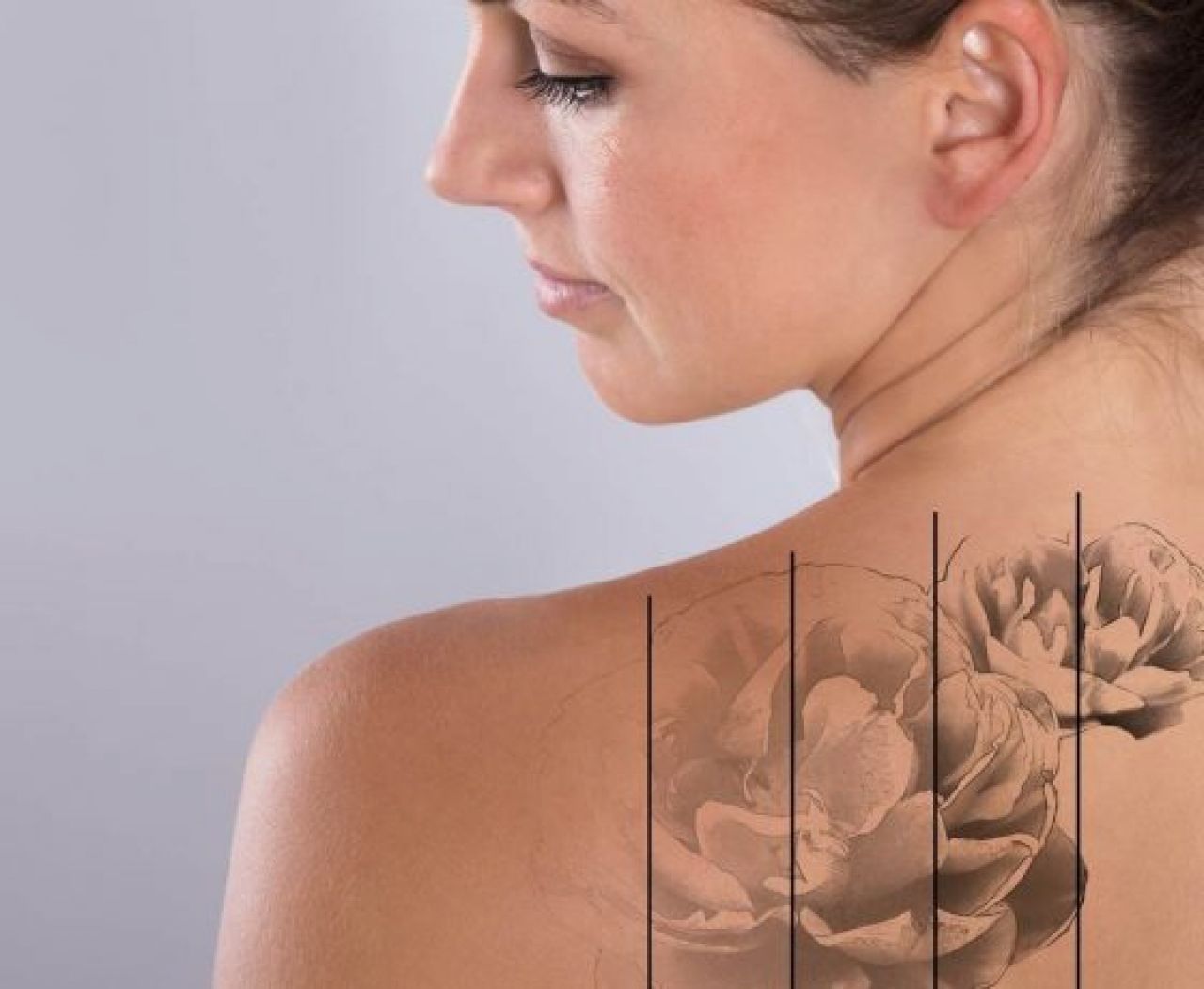 Czy usunięcie tatuażu jest możliwe i czy jest bolesne ?
